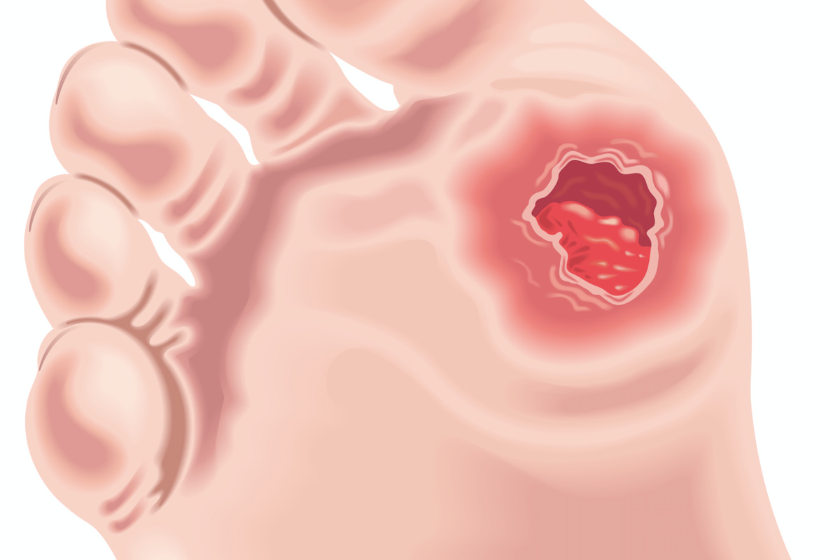 calzature-orthosan-diabetici